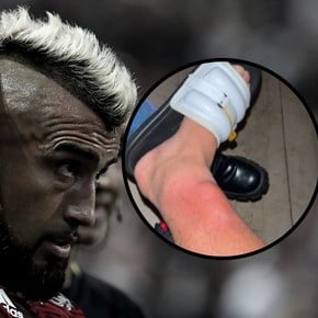 Impacta: así le quedó la pierna a Vidal a días de la Libertadores